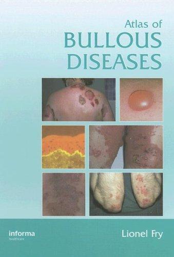 Atlas of Bullous Diseases