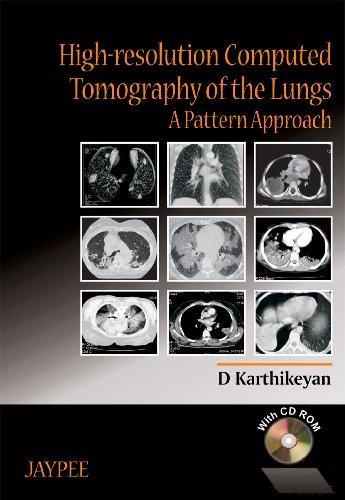 High-Resolution Computed Tomography of the Lungs: A Pattern Approach with CD-ROM