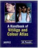 A Handbook of Vitiligo and Colour Atlas