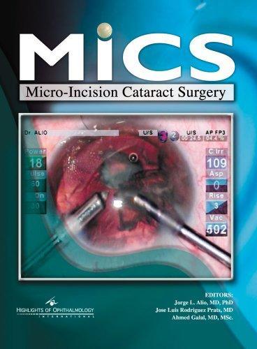 MICS Micro-Incision Cataract Surgery with CD-ROM