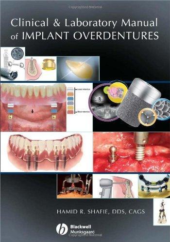 Clinical and Laboratory Manual of Implant Overdentures 