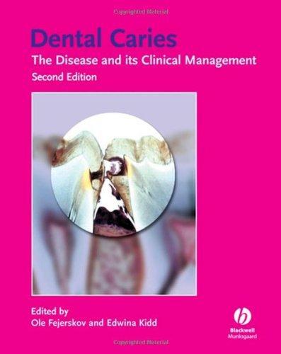 Dental Caries: The Disease and Its Clinical Management, 2nd Edition