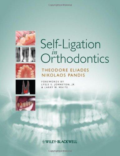 Self-Ligation in Orthodontics: An Evidence-Based Approach to Biomechanics and Treatment