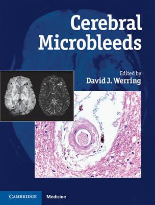 Cerebral Microbleeds: Pathophysiology to Clinical Practice